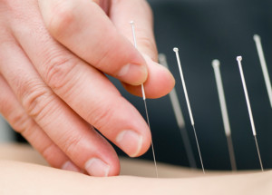 What acupuncture can do for you?