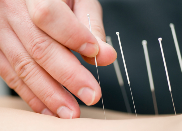 What acupuncture can do for you?